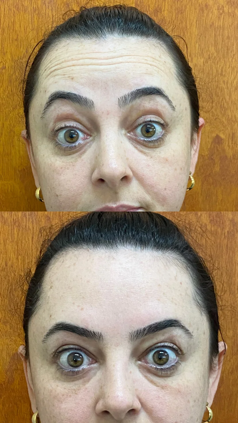 Antes e depois de Botox na testa
