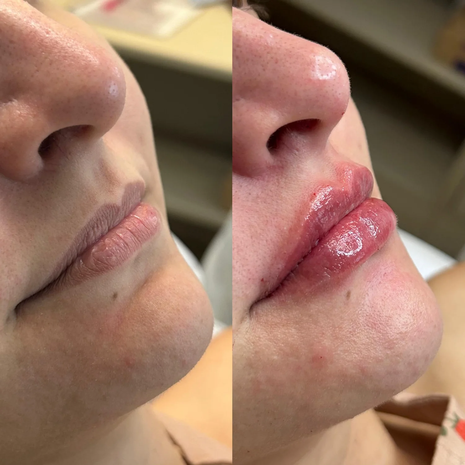 Perfiloplastia e harmonização facial antes e depois