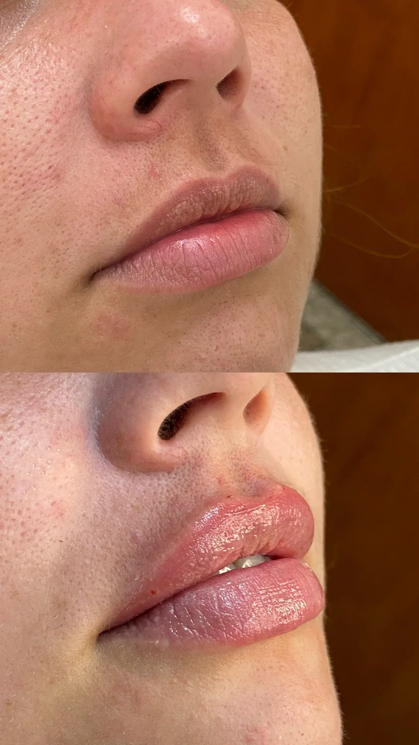 Preenchimento labial natural em Fernandópolis