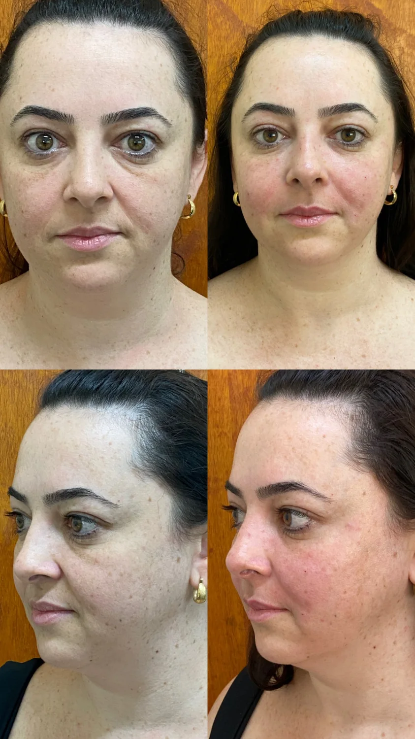 Antes e depois de preenchimento de olheiras e bigode chinês